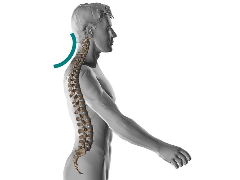 Osteocondrose cervical da coluna, causando muitos sintomas desagradáveis