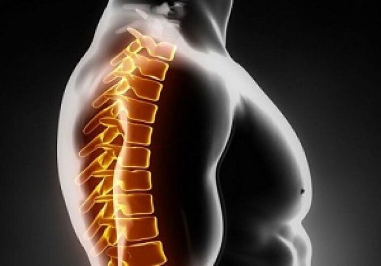 A osteocondrose torácica acompanha dor e desconforto no meio das costas