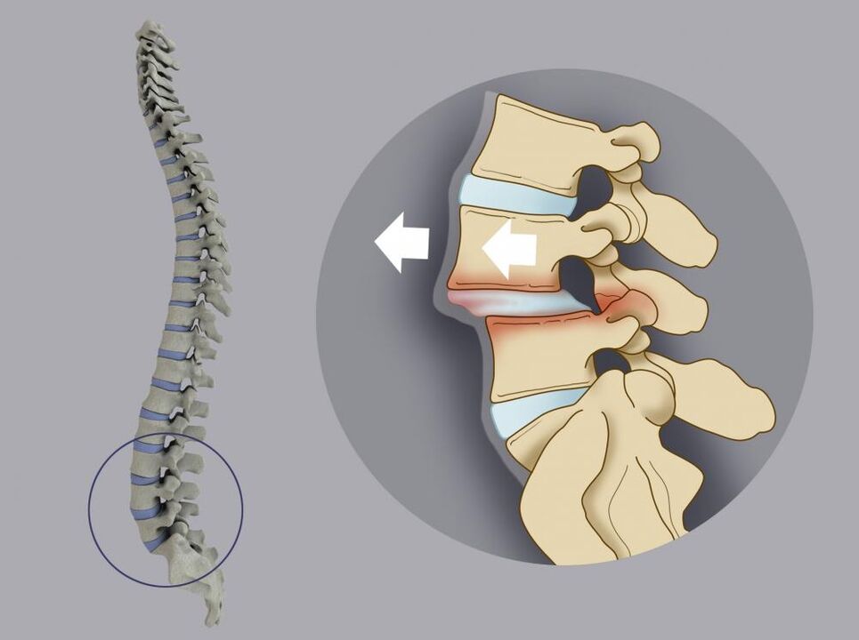 desalinhamento vertebral como causa de dor lombar
