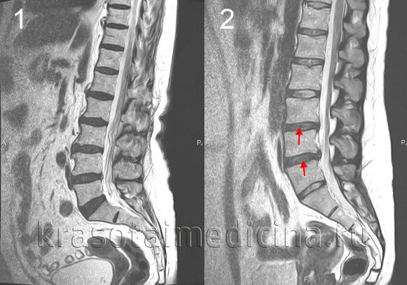 osteocondrose espinhal