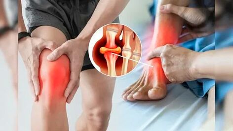 Áreas da pele adequadas para aplicação do gel Icexin (joelhos, cotovelos, parte inferior das costas)